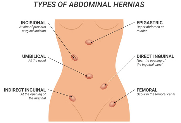 HerniaBodyImages HerniaBodyImages